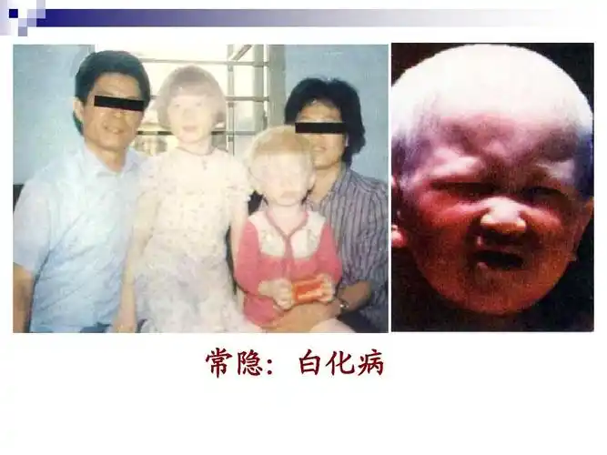 常隐: 常隐:白化病