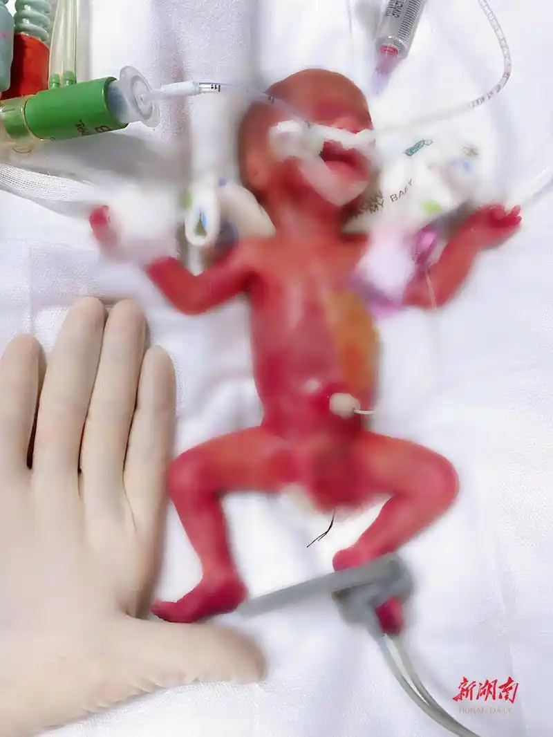 湖南"巴掌公主"救治成功创生命奇迹,刷新超低体重超早产儿救治记录