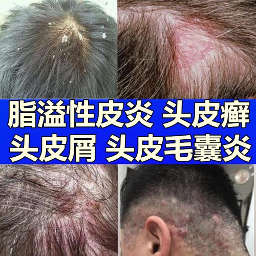 治头皮护理毛囊洗炎去螨虫除螨药物洗发水露头癣去屑止痒深层清理