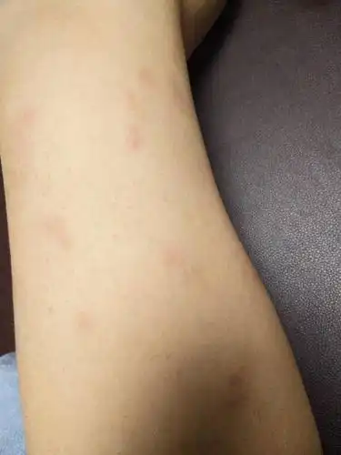 百度提问首页在线提问腿上起了这些红斑!不知道乍回事.,一按还有点疼
