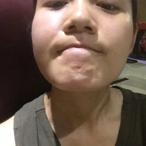 我下巴正中间长痣,不抬起来看不到,我也是最近看到,以前没发现,这