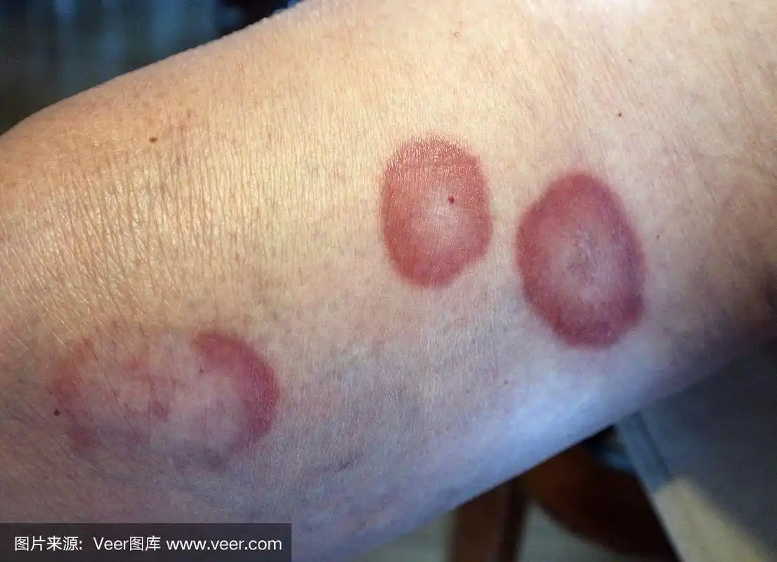 环形肉芽肿是一种罕见的皮肤病,发生在一位女性病人的腿上