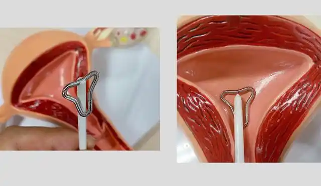 生完孩子要不要上节育环?别急,知道了这些再做决定也不迟