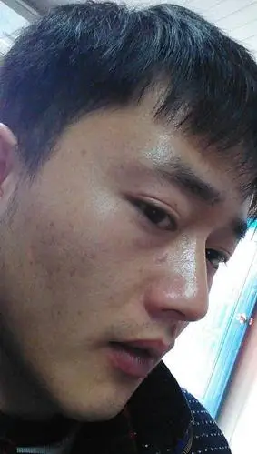 皮肤粗燥,毛孔粗大,暗黄,痘印,色