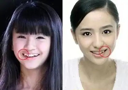 1 虎牙 在很多国家,牙齿不整齐是被视为缺点的.