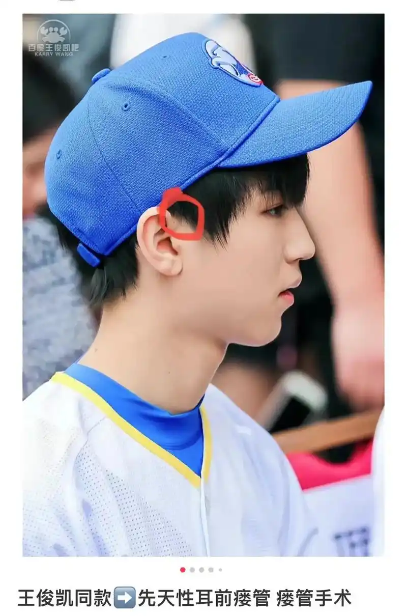3岁11个月,耳前瘘管手术.王俊凯同款耳前瘘管,在儿子没有发 - 抖音