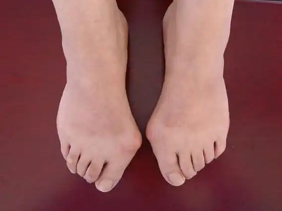 拇外翻是一种常见的足疾病,有的地方称为"大脚骨"或"大觚拐".