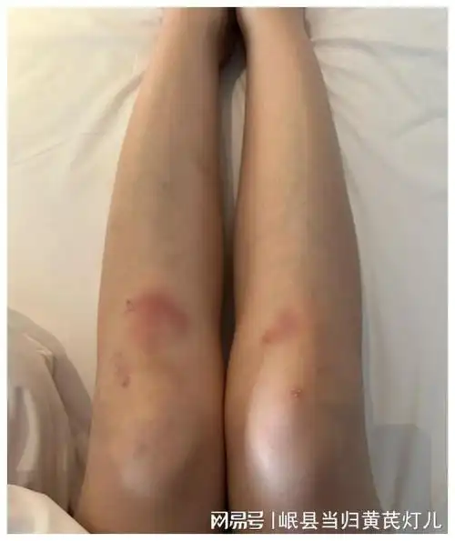 李依晓哭诉拍戏受伤不能自理膝盖红肿肋骨淤青眼睛布满血丝