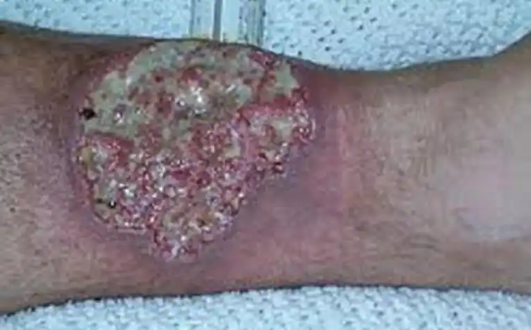 艾滋病初期溃烂症状图片