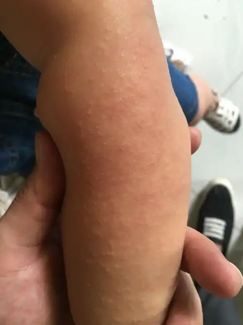 的小疙瘩,刚开始很少现在越来越多,去医院皮肤科医生说是接触性皮炎