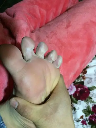 脚臭脚气脚发白脱皮是怎么回事