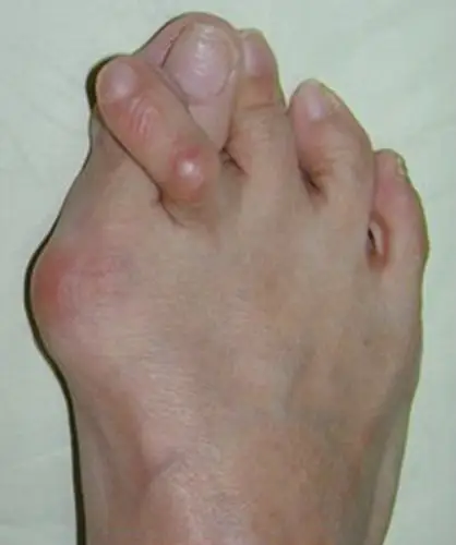 北京拇外翻医院_北京治疗拇外翻哪家医院好_北京治疗拇外翻最好的医院