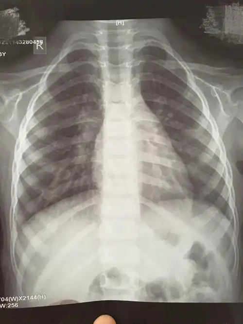 孩子3周岁多点,支气管肺炎入院治疗,6天后,孩子明显好转,医生依然让
