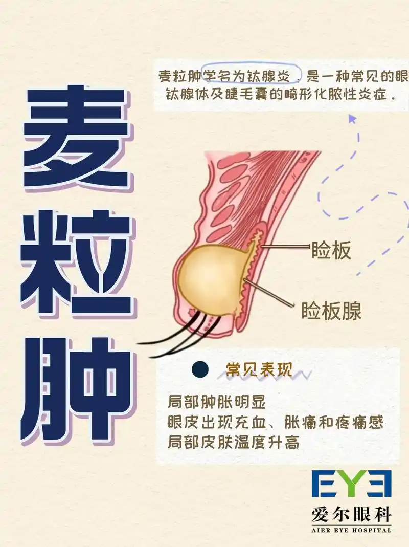 眼科小知识(麦粒肿)一分钟快速了解麦粒肿#眼睛 #麦粒肿 # - 抖音