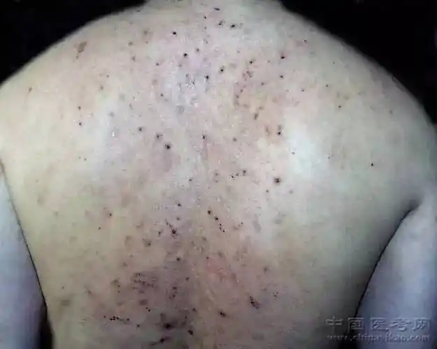 史上最全的皮肤病图谱吐血整理