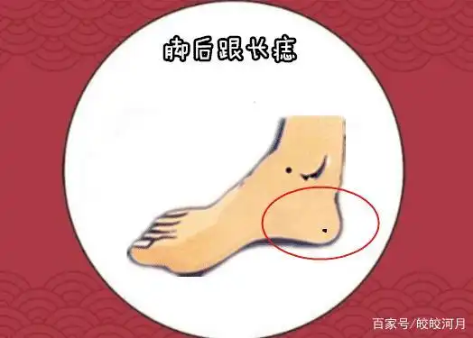 脚后跟长痣