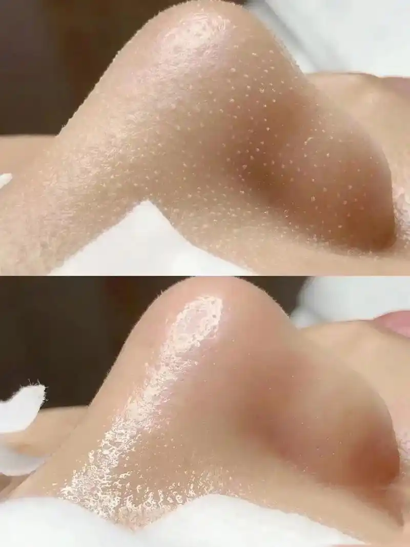 毛囊清洁术,治愈系的皮肤管理 做闪闪发光的你 - 抖音