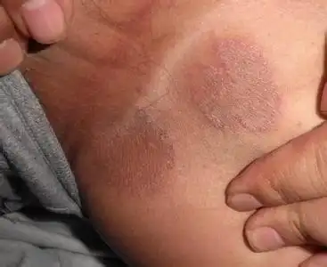 股癣图片啥样?麻烦给一个,和别的炎症区别大不大