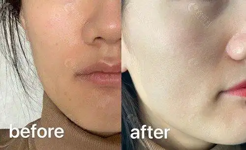 光子嫩肤改善皮肤暗沉粗糙,毛孔粗大前后对比图