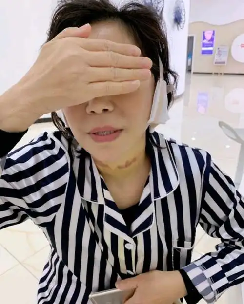 做的小切口拉皮 头颈.现在第7天了,伤口缝合部位还_圈子-新氧美容整形