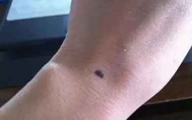 手腕处有痣代表了什么 是好是坏?