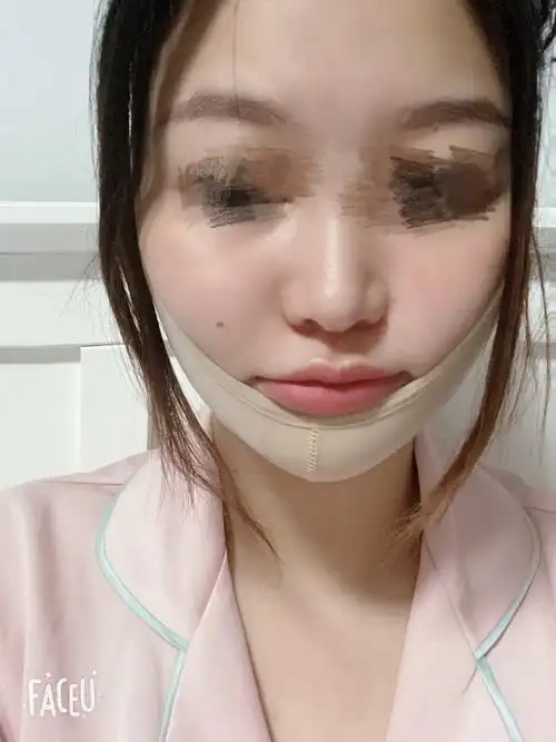 做完面部吸脂的第10天啦恢复的很好