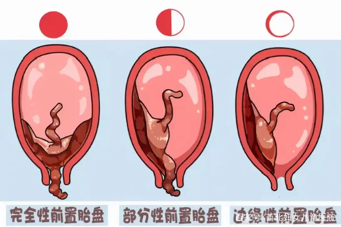 吓坏了!前置胎盘这么可怕,准妈妈需要知道这几点!