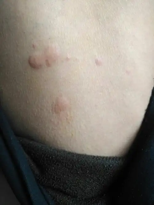 今早起来腿上起了这样的大疙瘩,好些个,又硬又痒,有硬币的大小,请问是