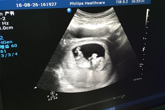 12周b超男女腿部间的区别图正如上面所说,12周的时候会做第一个孕期