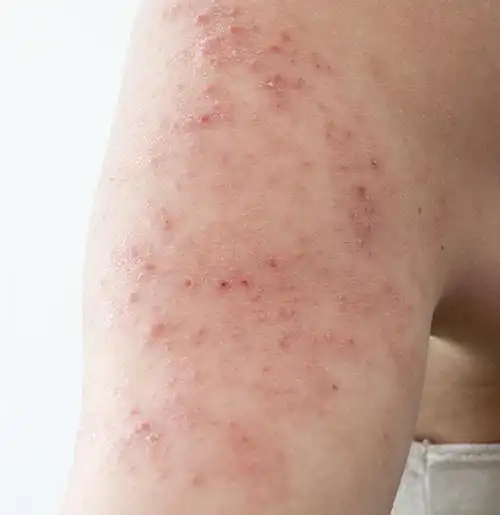 小心过敏性皮炎突袭!_东莞南城肤康皮肤病科门诊部