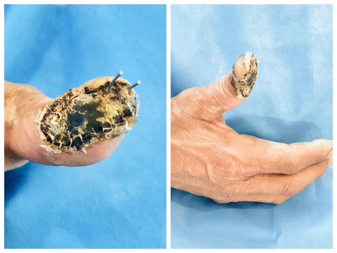 患者大拇指坏死,合肥京东方医院骨科显微技术"移花接木"足趾变手指