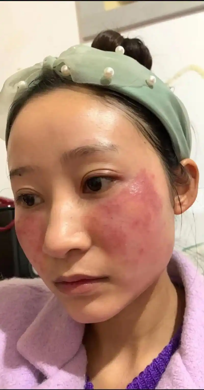 #问题性皮肤管理 #修复红血丝角质层薄 #七老董茵修复激素脸 - 抖音