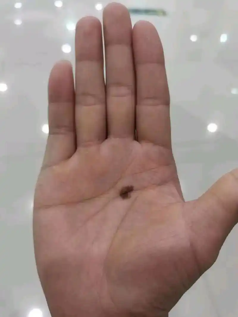 掌心痣#
