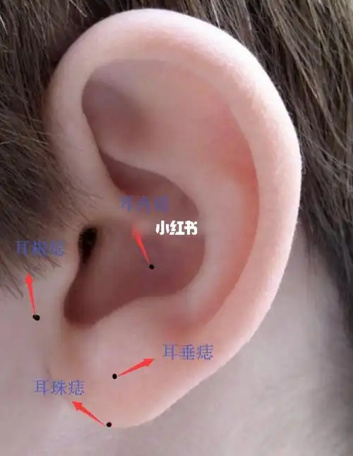 你耳朵上有痣吗