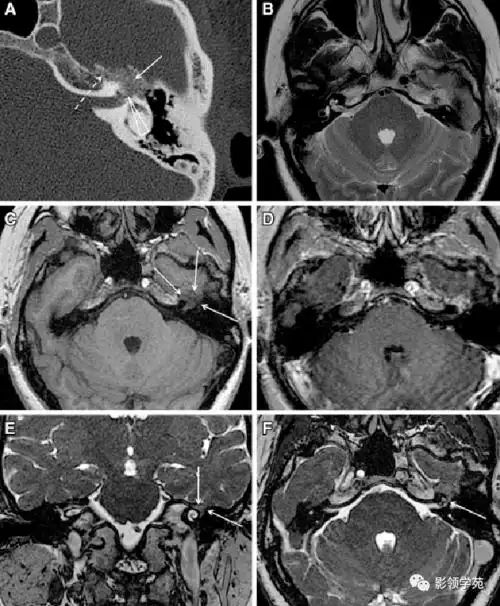 面神经解剖及相关病变