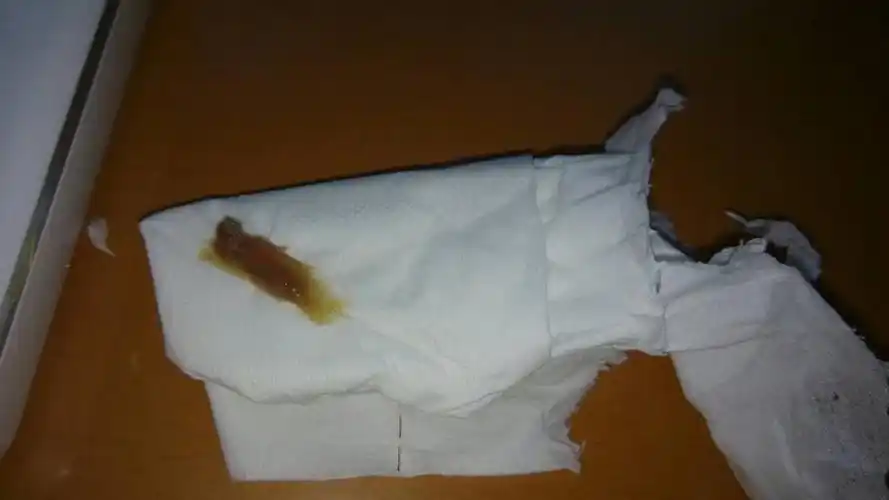 其他回答 你好,白带褐色如在两次月经中间少量阴道流血,为排卵期逞