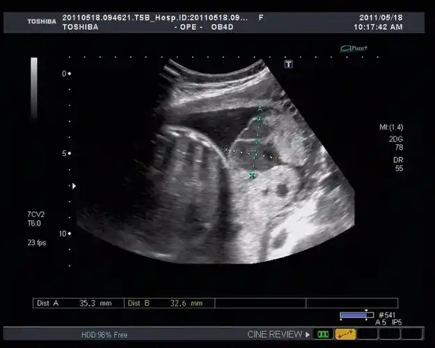 胎盘血管瘤与血池