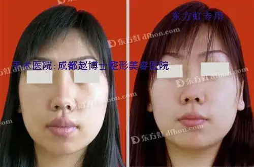 整形医院提供的唇部整形对比照_整容手术过程图片_整形前后效果图