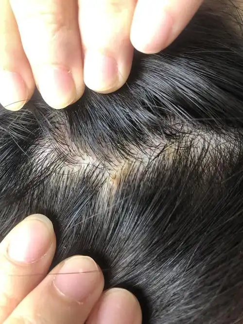 有朋友头皮得过脂溢性皮炎的吗(有图,慎入)