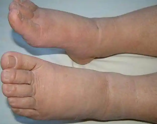 若这4个症状一出现可能说明肝癌早期了很多人不当一回事