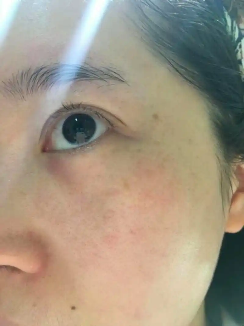 眼角长斑是指在眼睑或眼角周围出现的色素沉着或色素斑点.