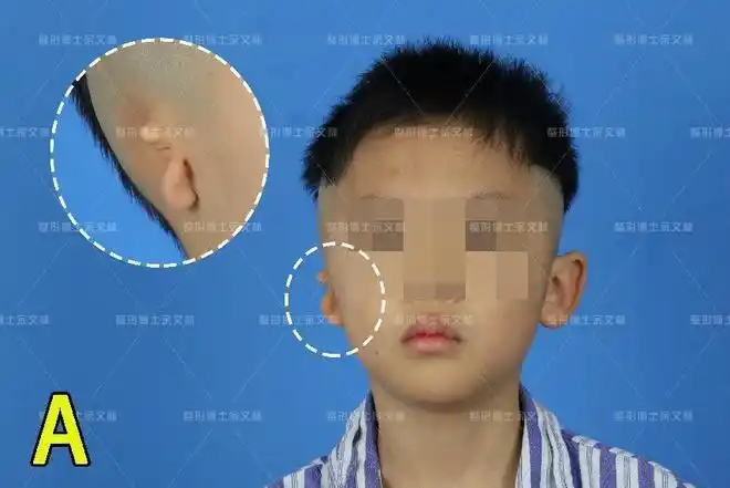 男孩右边小耳畸形,选择扩张法耳再造,耳朵终于正常了|手术|耳廓|肋
