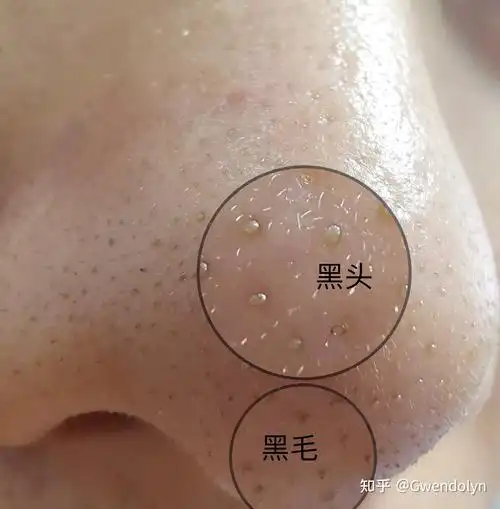 怎么收缩毛孔去黑头最有效