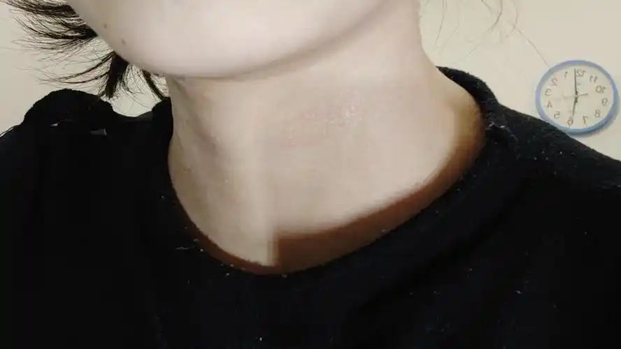 jms帮我看看脖子上的这个是藓吗?不可怕