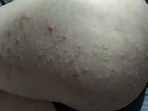 我的屁股上有小包,很痒