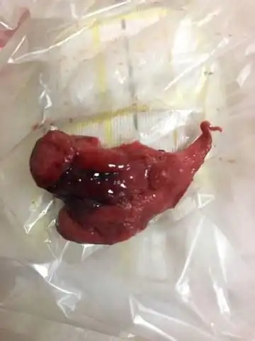 刮出来的是血块,其中有胎儿,有胎盘组织.子宫内同