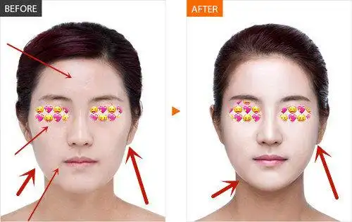 全脸脂肪填充真人前后对比图