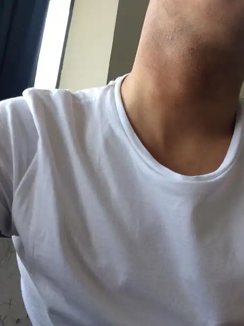 脖子上有块黑的,不痛也不痒,就是脖子黑的这块长了很多像胡须一样的小