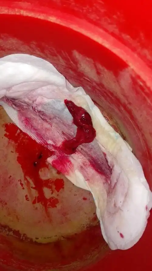 大出血有什么后遗症相关文章