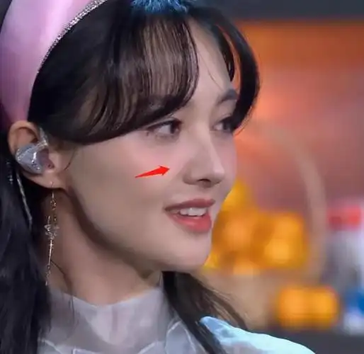 郑爽的鼻侧突然出现了疑似疤痕的凸起,正好围绕着半边鼻子,还有很规律